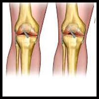 Arthritis